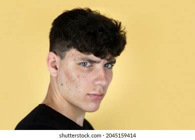 Many Pimples On Face Teenage Boy Stock Photo 2045159414 | Shutterstock