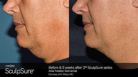 SculpSure in Toronto / For Men And Women! - Ontario Men's Health