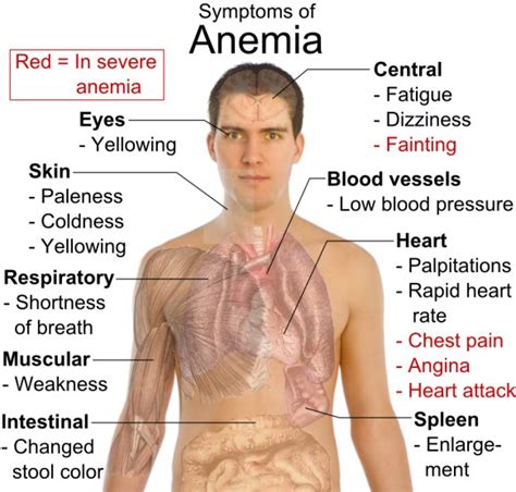 Megaloblastic Anaemia (Vitamin B12 Deficiency) – HealthAid®