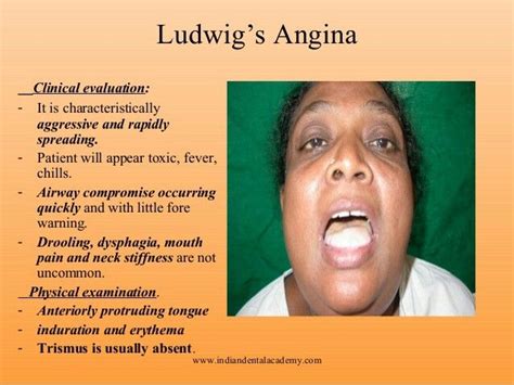 Ludwig angina gs mouth | Oral pathology, Medical school essentials, Dermatology