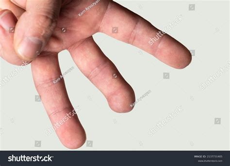 Amputated Finger Closeup Man Finger Stock Photo 2137731405 | Shutterstock