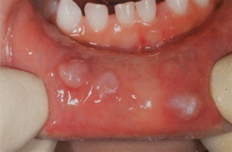 Mucocele Floor Of Mouth