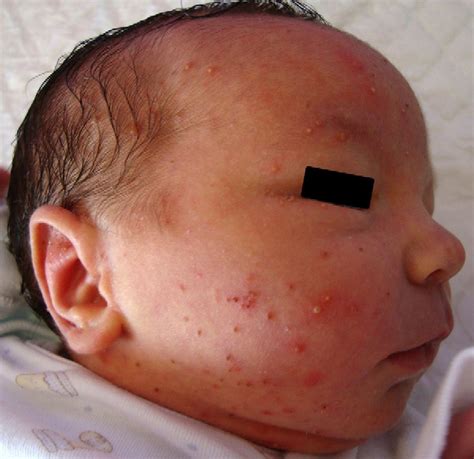 Transient Neonatal Pustular Melanosis | Actas Dermo-Sifiliográficas