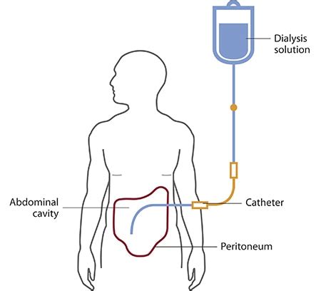 Peritoneal Dialysis - NIDDK