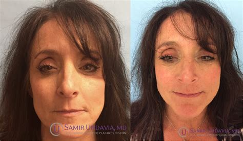 Juvederm for Nasolabial folds and marionette lines | Botox fillers ...