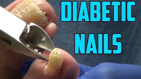 Diabetic Nails Need Big Musical Treatment - YouTube