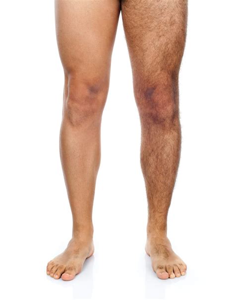 Leg hair removal | Men | Solution Clinic