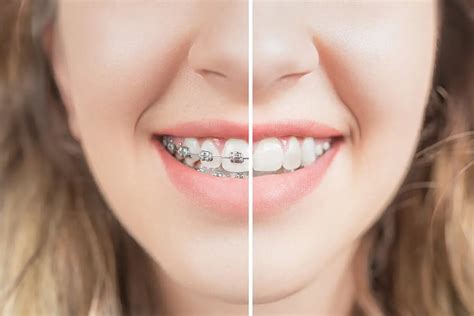 Before And After Braces | Orthodontic Services | Johns Creek GA