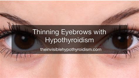 Thinning Eyebrows with Hypothyroidism - The Invisible Hypothyroidism