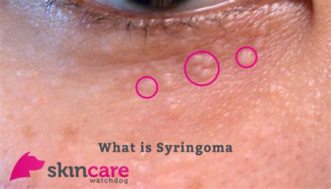 Bca Syringoma Ytreatment - mentallasopa