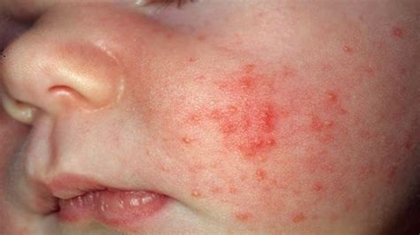 Newborn Baby Acne: Causes and Treatment | Rahet Bally