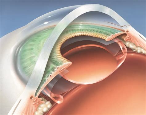 Replacing lens after cataract surgery