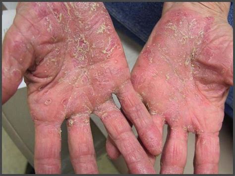 Psoriasis on hands pictures | Psoriasis expert