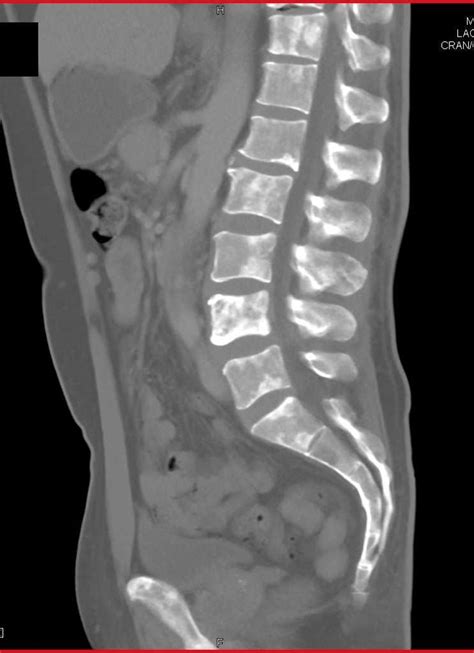 Multiple Sclerotic Bone Lesions Due to Myeloma / CTisus.com in 2021 | Case study, Medical ...