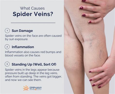 How to Get Rid of Spider Veins on Your Legs, Face, & Feet