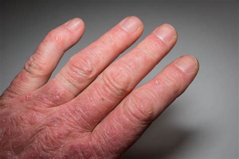 Symptoms of Psoriatic Arthritis - Eremedium