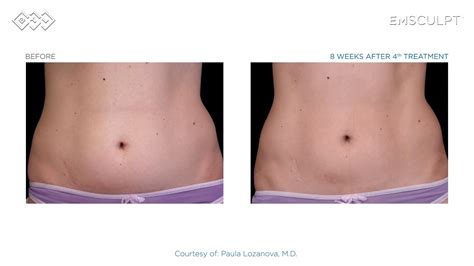 EMSCULPT® Results - YouTube