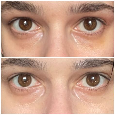 Lumi eyes : r/cosmeticsurgery