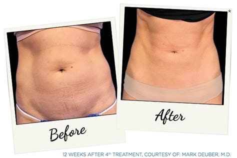 Emsculpt Before And After Real Patient Results, 43% OFF