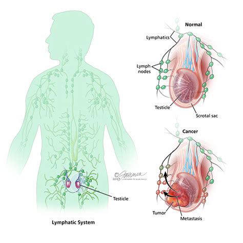 Urology Care Foundation - What is Testicular Cancer in Children?