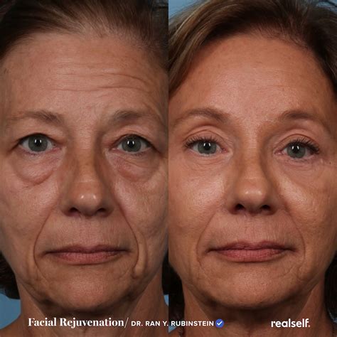 Drooping Eyelids | Brow lift surgery, Drooping eyelids, Facial procedure