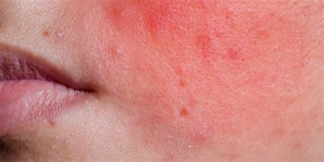 Most Common Causes of Localized Facial Rash | HealthNews