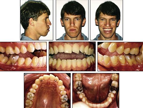 Treatment and retreatment of a patient with a severe anterior open bite ...