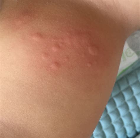 Dust Mite Skin Allergy Symptoms