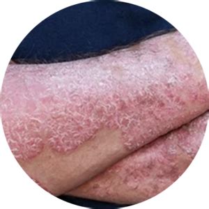 Psoriasis Treatment | DermOnDemand