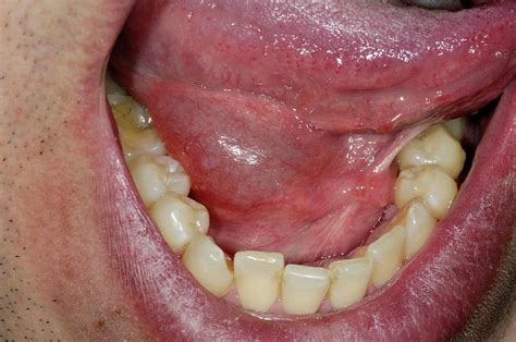 Salivary Gland Swelling