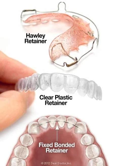 Orthodontic retainers – What you need to know