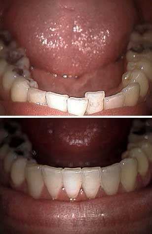 Invisalign and spring aligners are removable braces