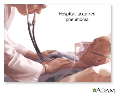 Hospital-acquired pneumonia - UF Health