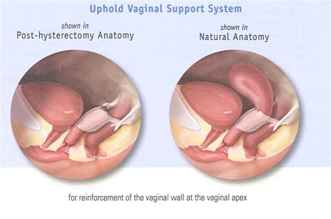 Pelvic Floor Prolapse Surgery Recovery | Review Home Co