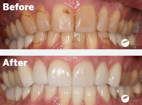 Veneers Before and After By Dr Kasen