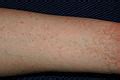 Scabies - Wikimedia Commons
