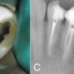 A: Second premolar with three root canals. B: Three orifices were ...