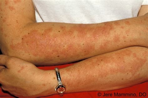 Subacute Cutaneous Lupus Erythematosus - American Osteopathic College of Dermatology (AOCD)