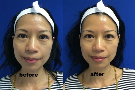 HydraFacial MD® Before and After – Mama In Heels