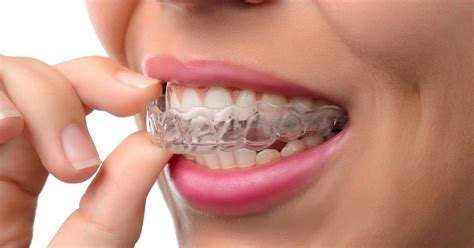 From Start to Finish: What to Expect From the Invisalign Process