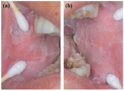 White Sponge Nevus Caused by Keratin 4 Gene Mutation: A Case Report