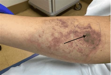 Cureus | Brown Recluse Spider Bite Resulting in Coombs Negative Hemolytic Anemia in a Young Male ...