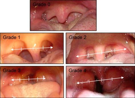 Tonsillitis Grading