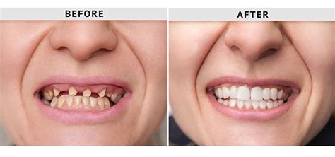 Dental Bridge Before And After