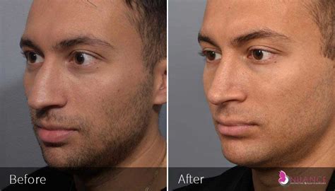 Chin Implant Surgery | Chin Augmentation in Las Vegas, NV