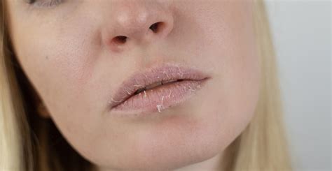 Managing Eczema on Lips: Causes & Treatments | Clinikally