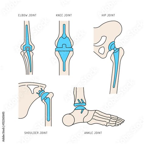 Medical illustration of the implantation of the bone joints in the human skeleton. Layout of ...