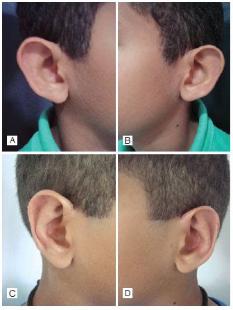 RBCP - Correction of prominent ears by the cartilaginous incision ...