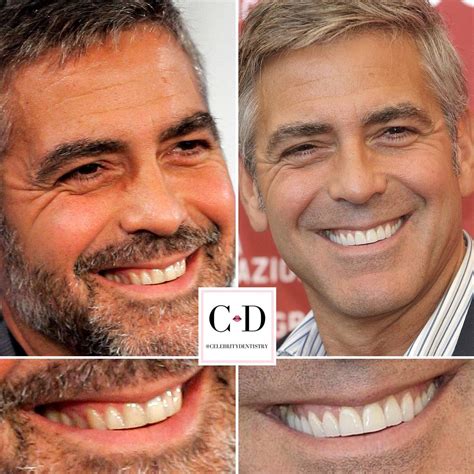 George Clooney’s Smile Makeover... - CelebrityDentistry