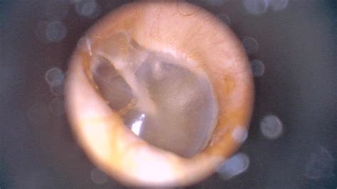 Insane in the (Tympanic) Membrane | BROWN MED-PEDS